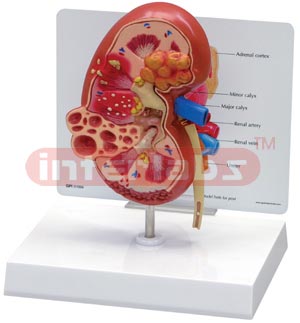 Diseased Kidney